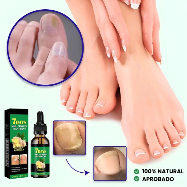 Tratamiento Natural Antifúngico en 7 Días